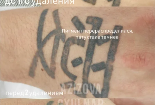 студия эпиляции и удаления тату elos фото 4 - tattooo.ru